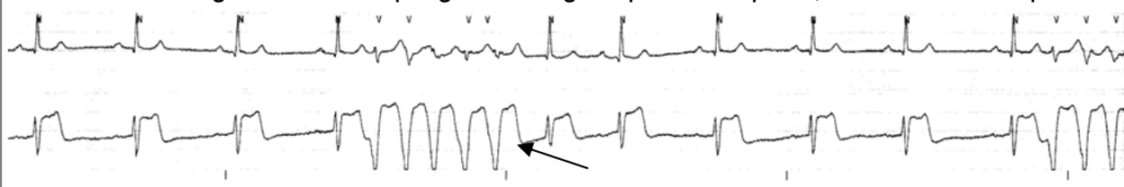 ECG: Ventricular tachycardia (VT)
