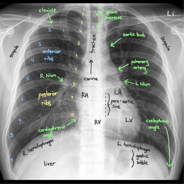 How to Read Chest X-Ray - FreeMedicalMCQs.com